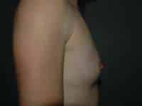 Breast Augmentation