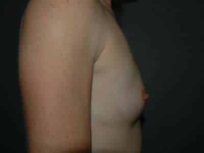 Breast Augmentation