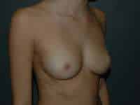 Breast Augmentation