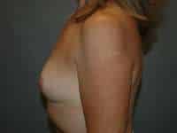 Breast Augmentation