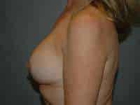Breast Augmentation