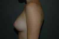 Breast Augmentation