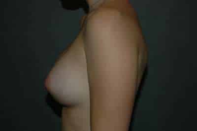Breast Augmentation