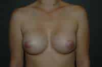 Breast Augmentation