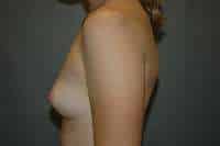 Breast Augmentation