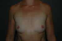 Breast Augmentation
