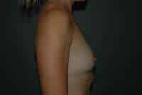 Breast Augmentation