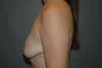Breast Lift