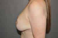 Breast Lift