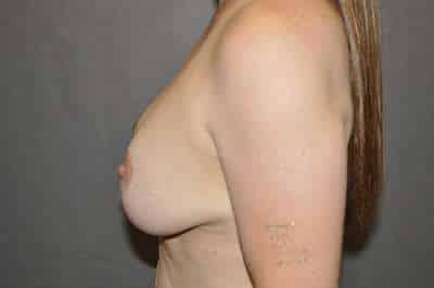 Breast Lift