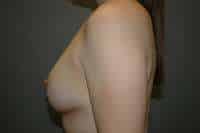Breast Lift