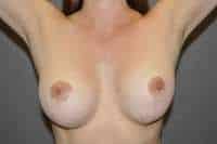 Breast Lift
