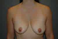 Breast Lift