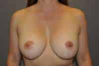 Breast Lift
