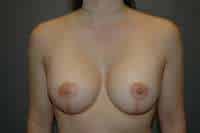 Breast Lift