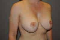 Breast Lift