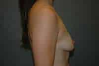 Breast Lift