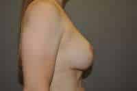 Breast Lift