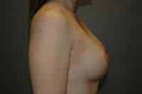 Breast Lift