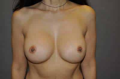 BREAST IMPLANT EXCHANGE Before and After Results
