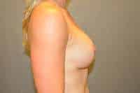 Breast Implant Exchange