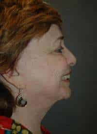 Facelift