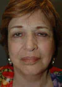 Facelift