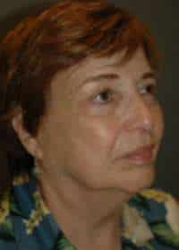 Facelift