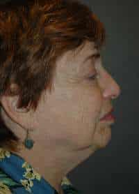 Facelift