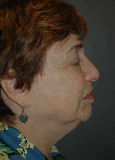 Facelift