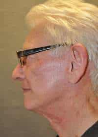 Male Facelift
