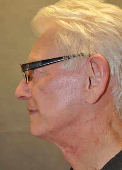 Male Facelift
