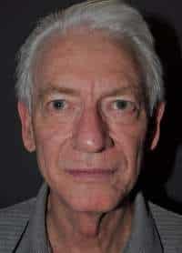Male Facelift