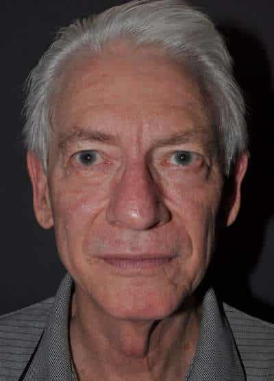 Male Facelift