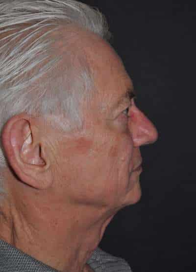 Male Facelift