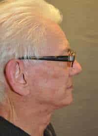 Male Facelift