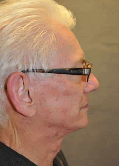 Male Facelift