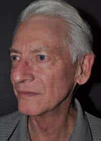 Male Facelift