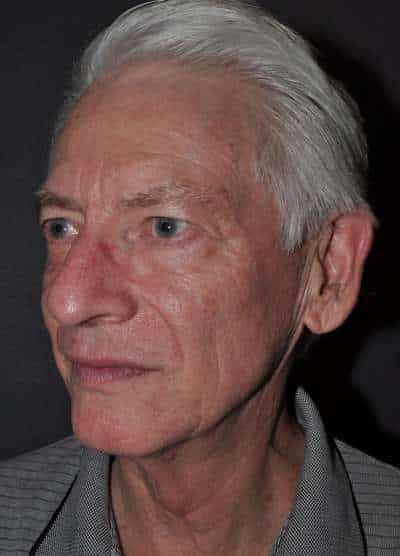 Male Facelift