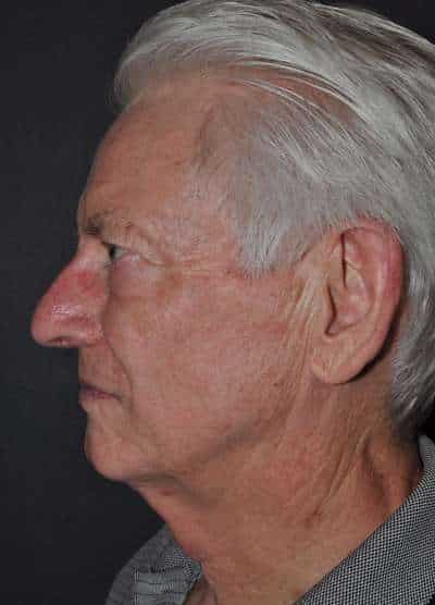 Male Facelift