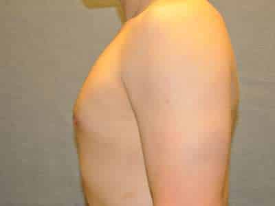 Gynecomastia