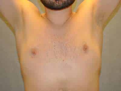 Gynecomastia