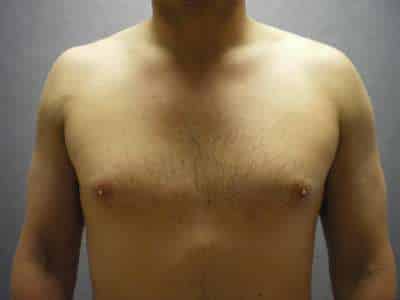 Gynecomastia