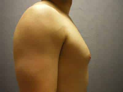 Gynecomastia