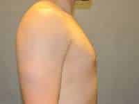 Gynecomastia