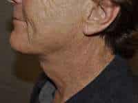 Neck Lift