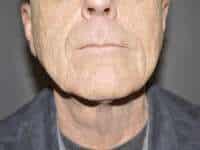 Neck Lift