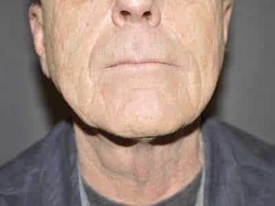 Neck Lift