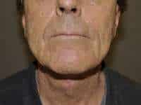 Neck Lift