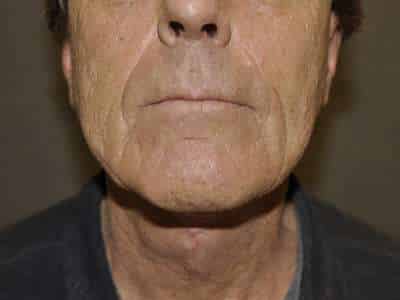 Neck Lift